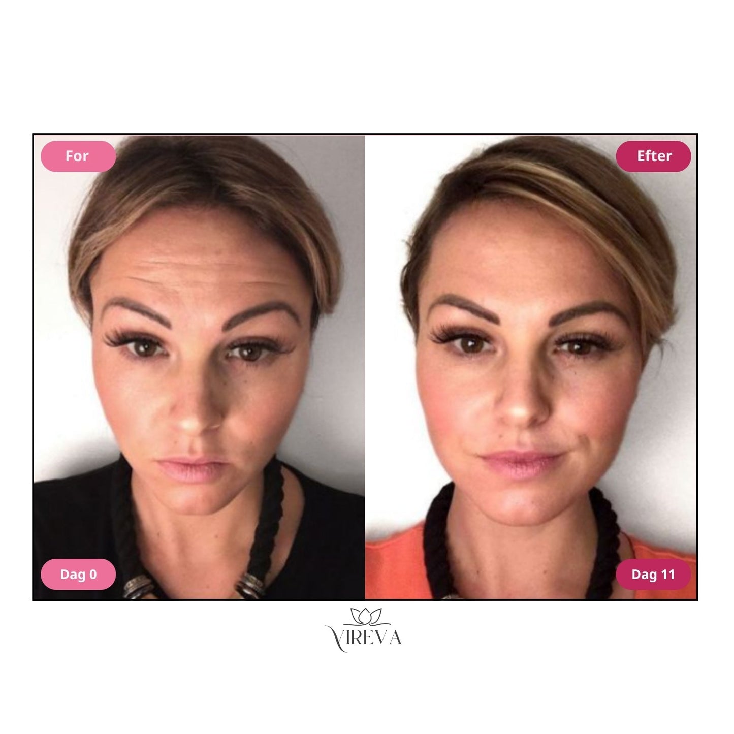 Glowvera™ Anti-Rynke Creme – 83 % færre rynker på 11 dage