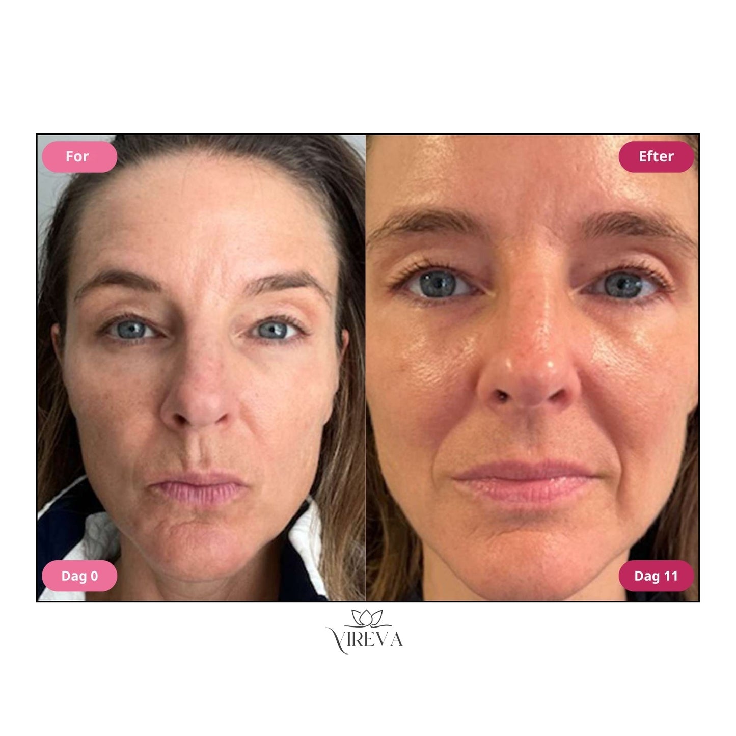 Glowvera™ Anti-Rynke Creme – 83 % færre rynker på 11 dage