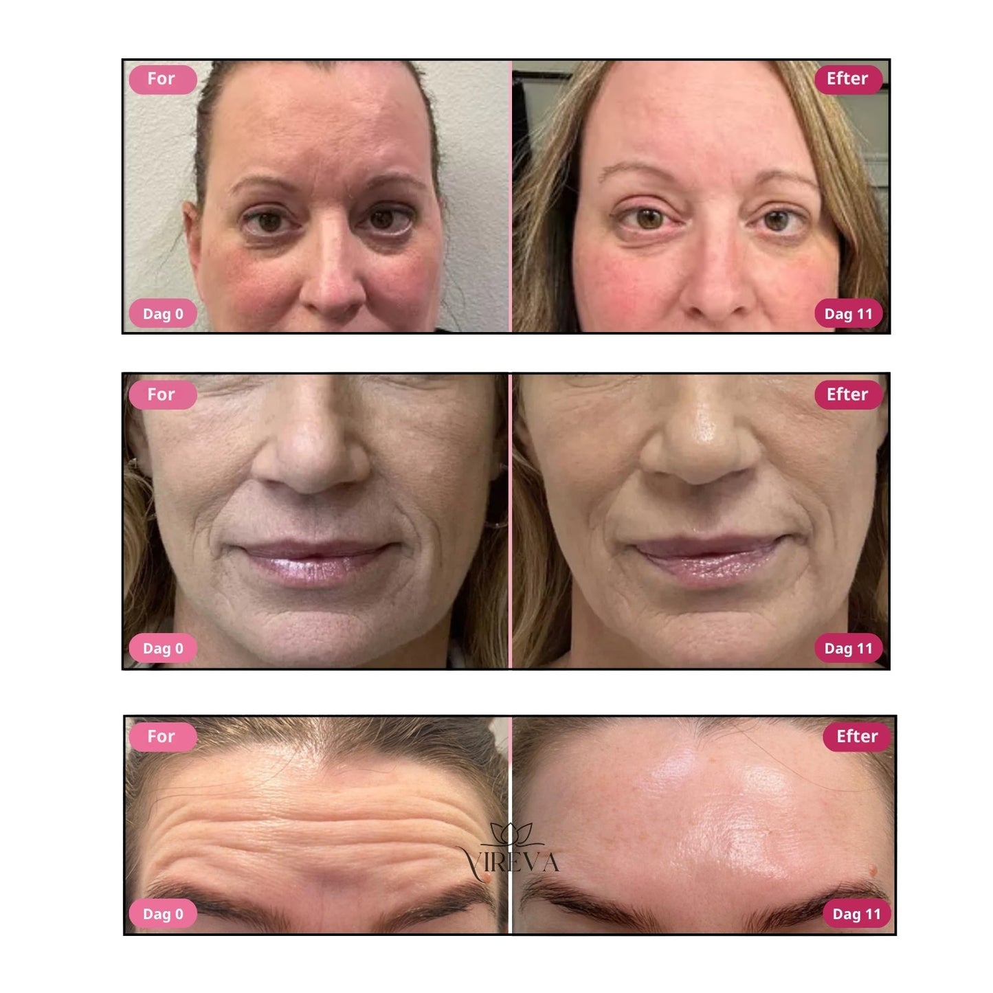 Glowvera™ Anti-Rynke Creme – 83 % færre rynker på 11 dage