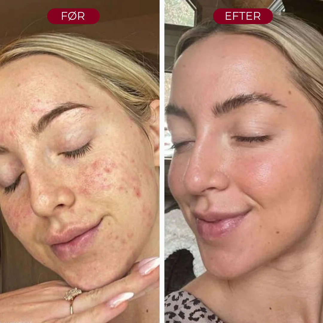 RiceRevital™ Essense Set | Serum Duo, fordi din hud kun fortjener det bedste
