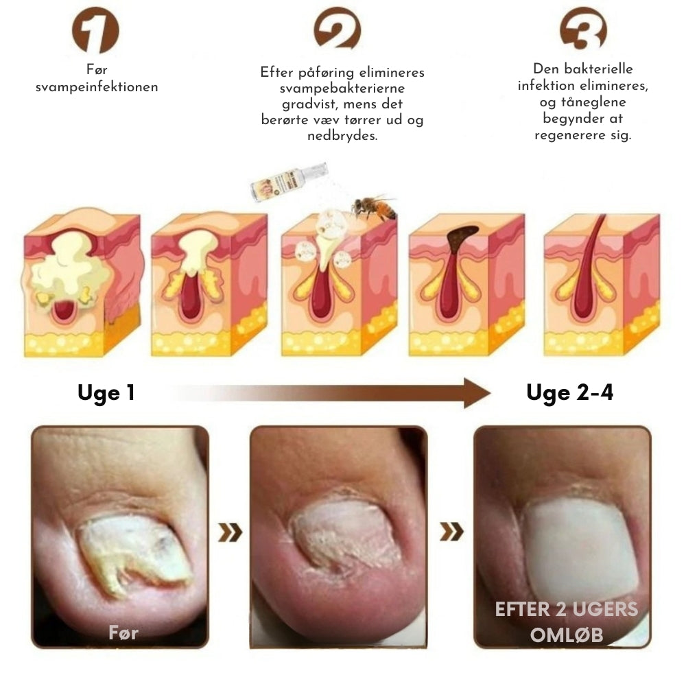 BeeGuard™ Neglespray – Farvel til neglesvamp på kun 14 dage!