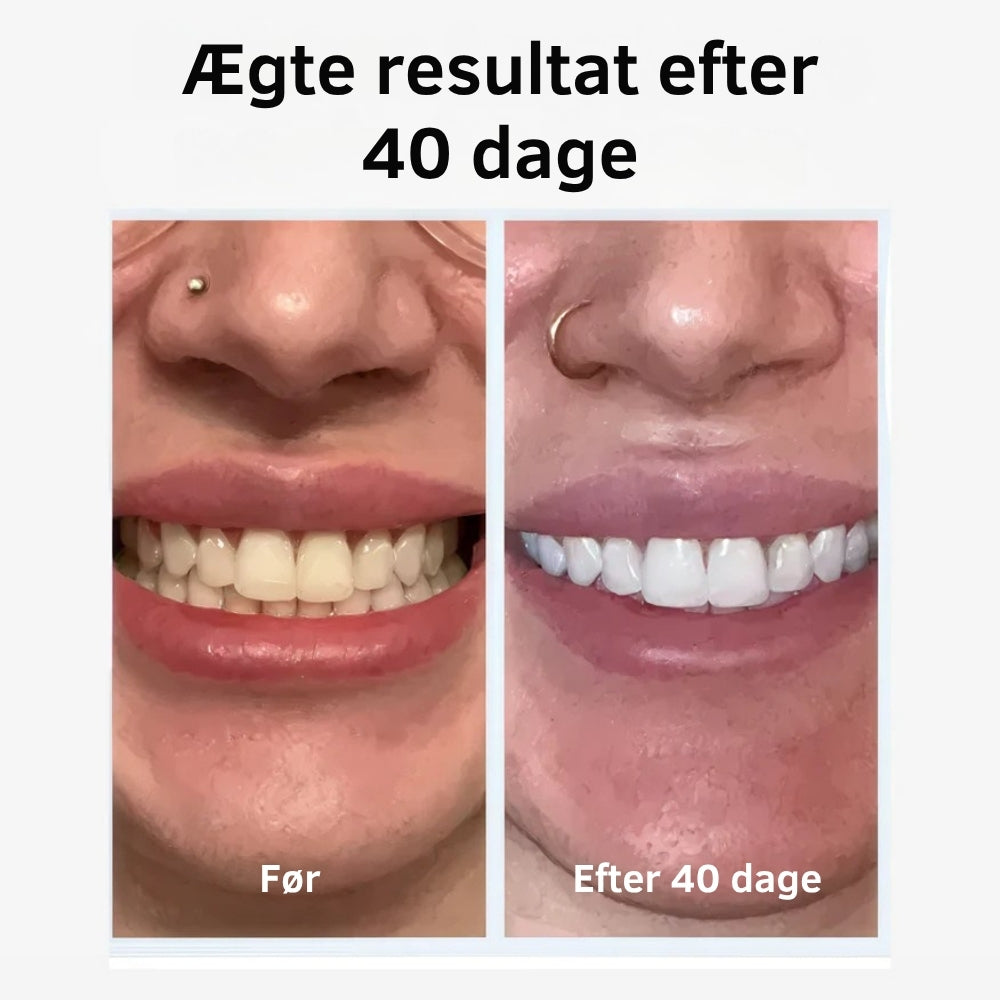 SonicSpark™ – ✨ Få Tandlægerene Tænder på Kun 30 Sekunder