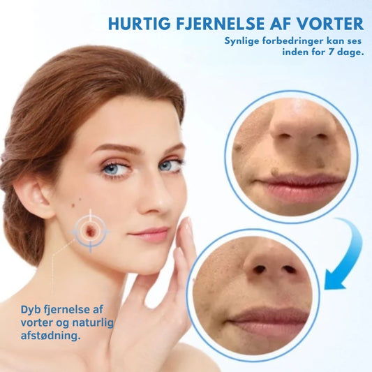 ✨ WattOff™ – Fjern vorter, hudflapper & knopper på kun 7 dage!