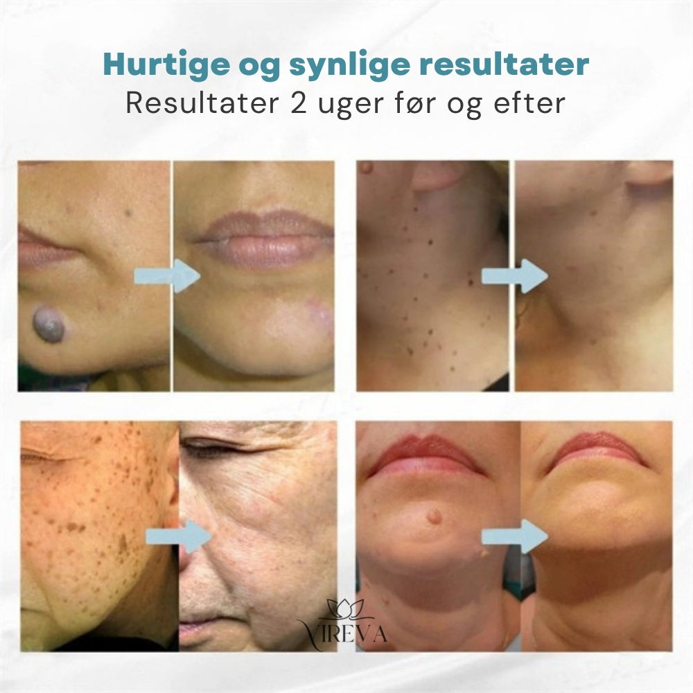 ZapFree™ Fjernelse af Modermærker og Vorter | Synlige Resultater på 48 Timer
