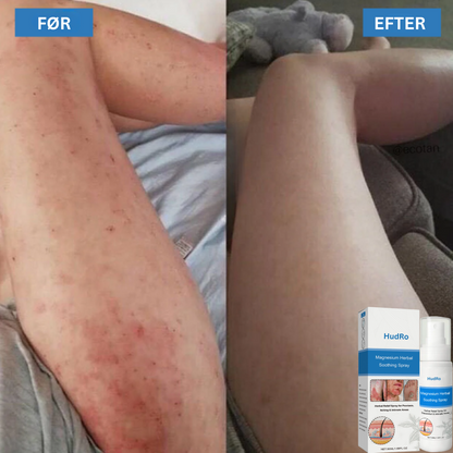 HudRo™ | Eksem Beroligende Hudspray