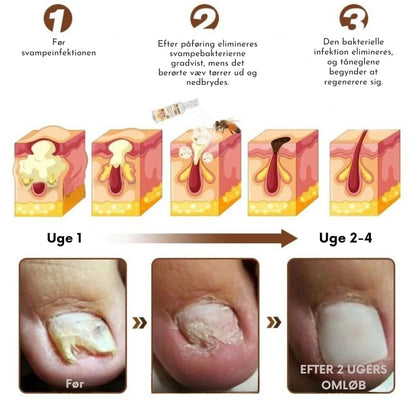 BeeGuard™ Neglespray – Farvel til neglesvamp på kun 14 dage!