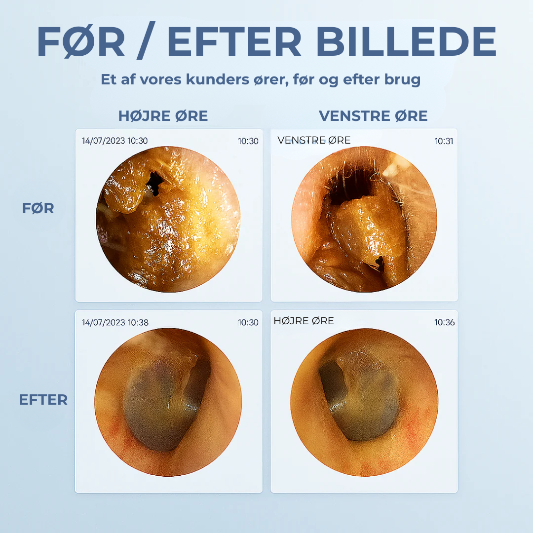 EarScope | Smart ørerengøring med avanceret teknologi