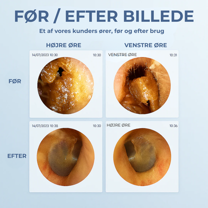 EarScope | Smart ørerengøring med avanceret teknologi