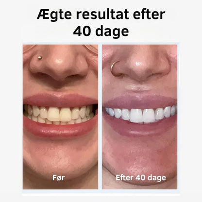 SonicSpark™ – ✨ Få Tandlægerene Tænder på Kun 30 Sekunder